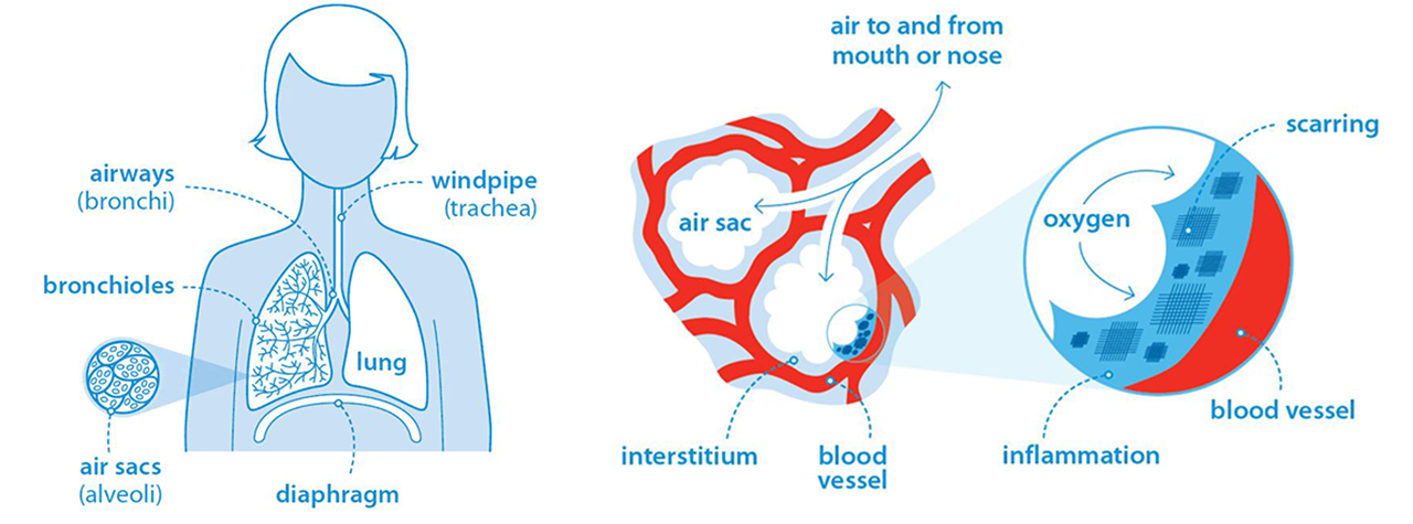 /Diagram%20of%20parts%20of%20lungs%20impacted%20by%20ILD