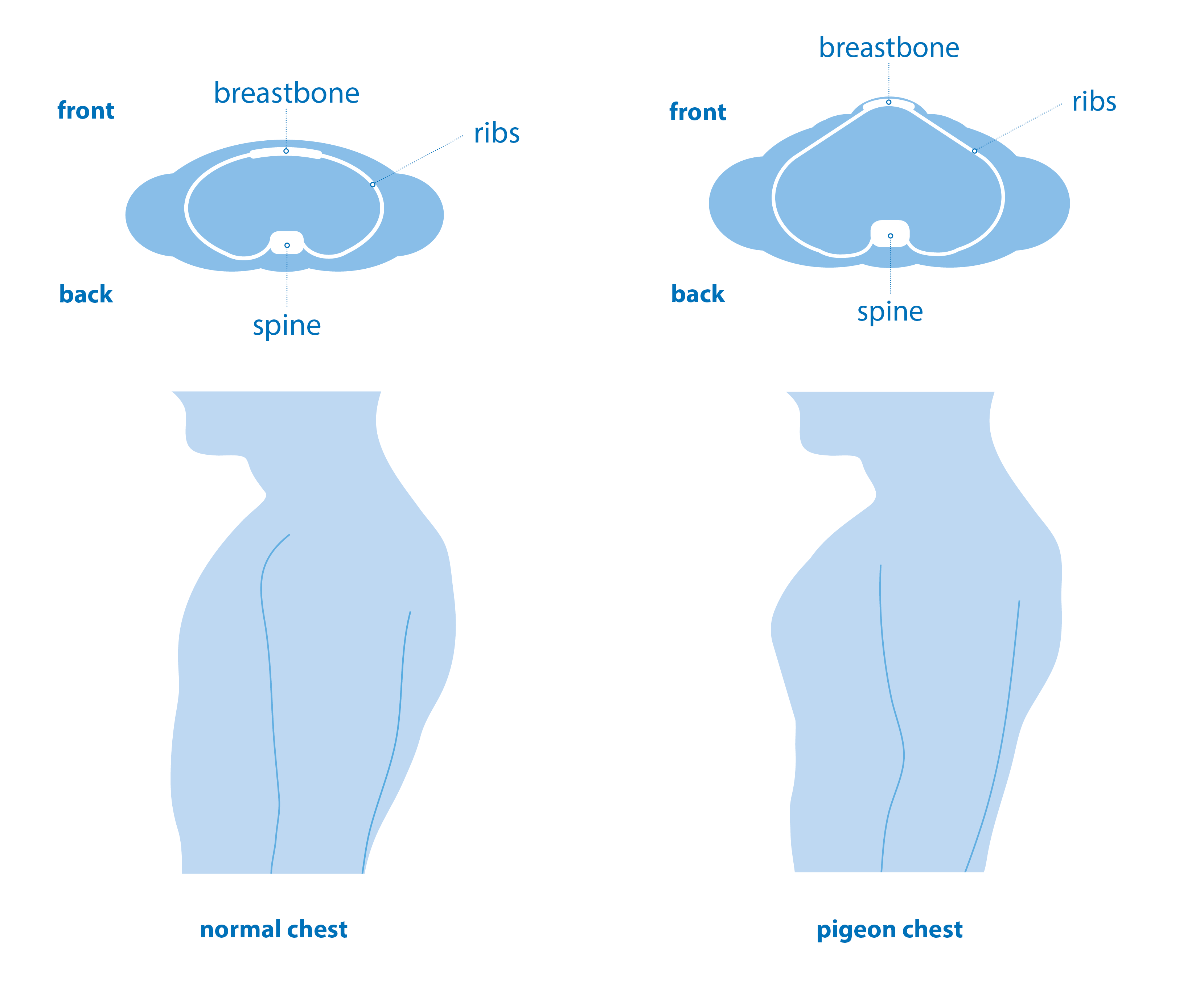 Barrel Chest Emphysema Pictures